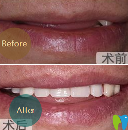 成都亞非牙科李顯軍半口牙種植前后效果對比圖