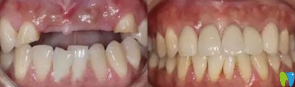 成都瑞爾口腔牙齒種植前后效果圖 成都瑞爾口腔牙齒種植前后效果圖