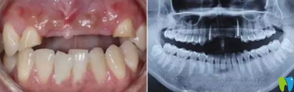 成都瑞爾口腔牙齒種植前 成都瑞爾口腔牙齒種植前