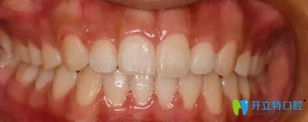 金屬托槽矯正牙齒一年半后效果
