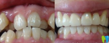 袁本瑤牙齒擁擠不齊矯正<span style= 袁本瑤牙齒擁擠不齊矯正<span style=