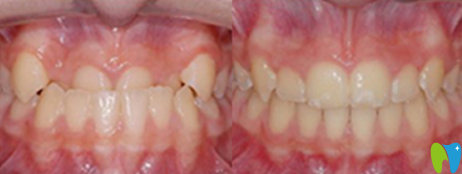 拜博口腔袁本瑤“地包天”矯正<span style= 拜博口腔袁本瑤“地包天”矯正<span style=