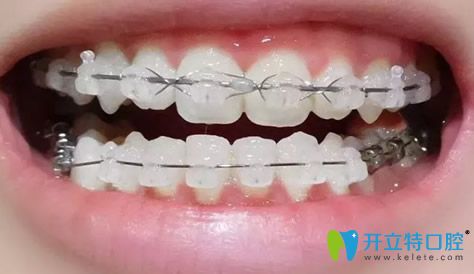 成都拜博口腔戴牙套10個(gè)月效果圖