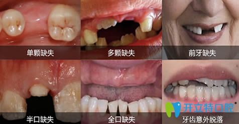 成都唐牙科各種牙齒缺失現(xiàn)象圖
