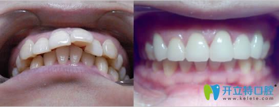 成都格林口腔牙齒正畸對比照片 成都格林口腔牙齒正畸對比照片