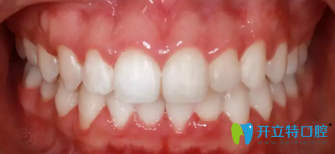 拜博口腔第11個(gè)月去掉牙套后牙齒照片
