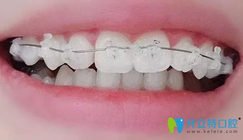 袁本瑤給我做牙齒矯正剛開始帶牙套時(shí)候樣子