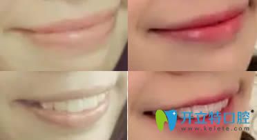 成都格林口腔牙齒正畸效果對(duì)比圖 成都格林口腔牙齒正畸效果對(duì)比圖