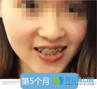 金屬托槽牙齒矯正5個月 金屬托槽牙齒矯正5個月
