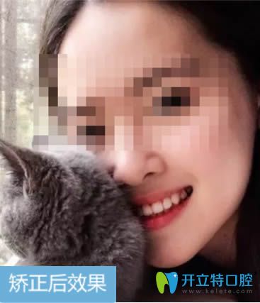 28歲的我在深圳拜爾佩戴自鎖金屬托槽12個月的效果 28歲的我在深圳拜爾佩戴自鎖金屬托槽12個月的效果