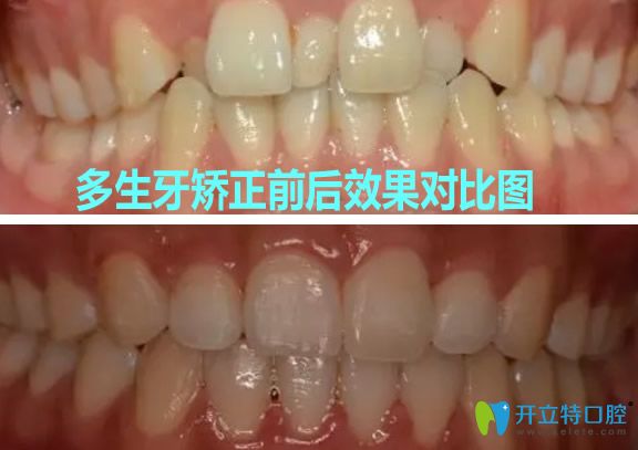 利爾口腔匯金店牙齒矯正效果案例