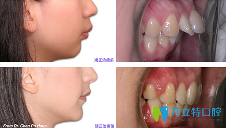 廈門天使口腔齙牙矯正前后對(duì)比圖