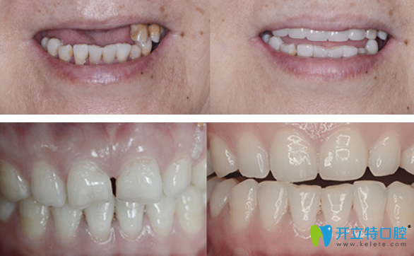 牙祖口腔種植牙+美容修復(fù)效果案例 牙祖口腔種植牙+美容修復(fù)效果案例