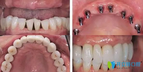 譚建武院長牙齒種植案例 譚建武院長牙齒種植案例