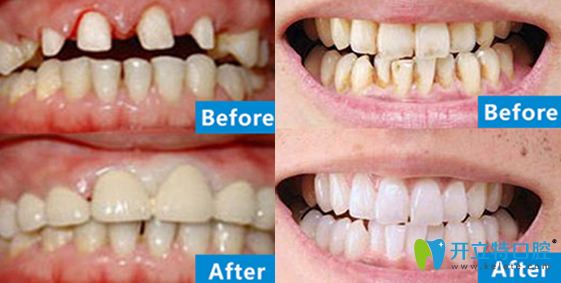 北極星口腔牙齒瓷貼面+牙齒冷光美白案例 北極星口腔牙齒瓷貼面+牙齒冷光美白案例