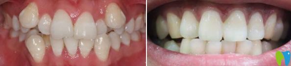 美奧口腔牙齒矯正前后對比圖