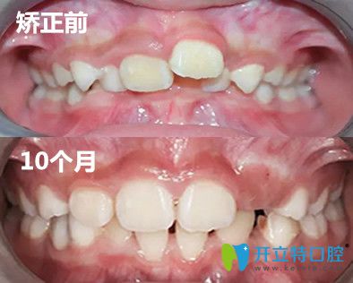 兒童MRC矯正案例對比圖 兒童MRC矯正案例對比圖