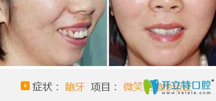 聊城哪家醫(yī)院牙齒正畸好？看聊城口腔微笑全隱形牙齒矯正案例對比圖