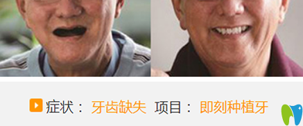 屬于聊城口腔醫(yī)院的牙齒缺失即刻種植牙案例