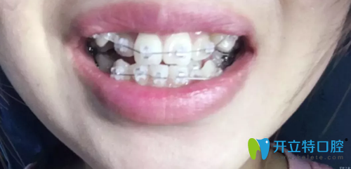 在無錫臻品口腔戴牙套第1天照片