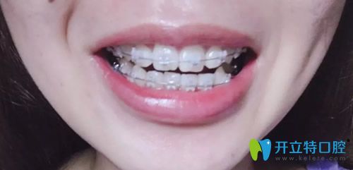 無錫臻品口腔戴牙套100天效果圖
