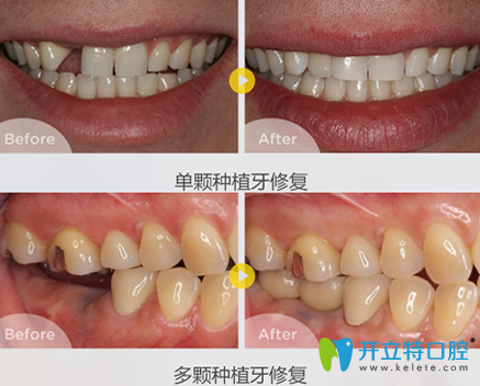 泰州北極星口腔姬輝種植牙前后效果對比圖 泰州北極星口腔姬輝種植牙前后效果對比圖