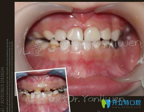維恩口腔蛀牙治療前后對比案例 維恩口腔蛀牙治療前后對比案例
