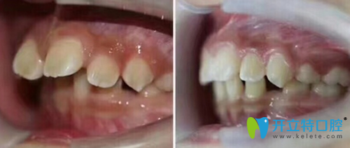 <!--<i data=20240703-sp></i>-->口腔9兒童門牙前突矯正案例 <!--<i data=20240703-sp></i>-->口腔9兒童門牙前突矯正案例