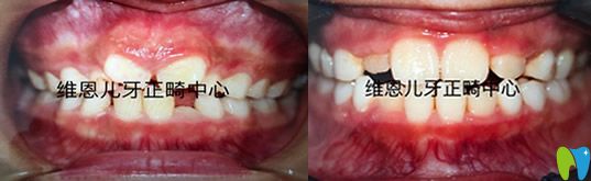 維恩口腔楊占娟為7歲兒童正畸案例