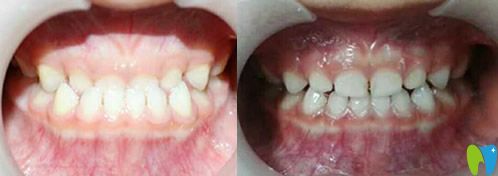 閆立文乳牙反頜(地包天)矯正案例 閆立文乳牙反頜(地包天)矯正案例