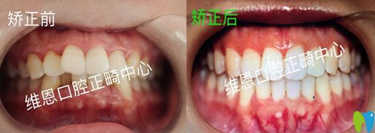 牙醫(yī)楊占娟怎么樣？看維恩口腔楊占娟真人案例