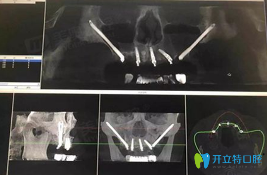 王明會(huì)診后給出了種植方案
