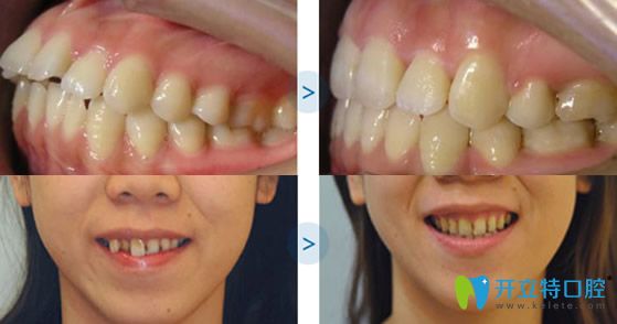 福州維樂(lè)口腔牙齒矯正術(shù)前術(shù)后對(duì)比案例