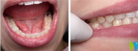 成都維朗口腔做種植牙效果圖