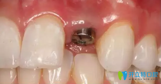 在北京齒康口腔剛植入人工種植體