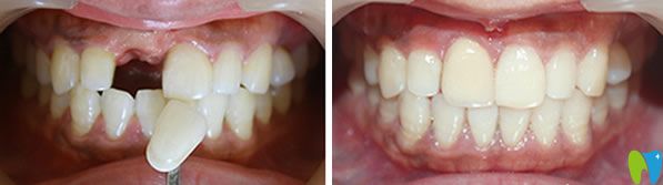 佳士潔口腔李永平院長(zhǎng)種植牙代表案例 佳士潔口腔李永平院長(zhǎng)種植牙代表案例