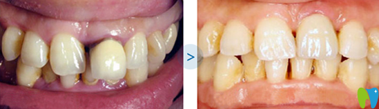 張俊偉烤瓷牙失敗修復(fù)案例