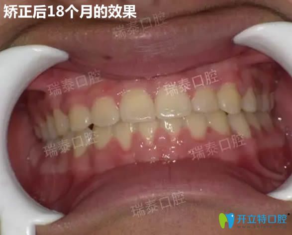 戴隱形牙套18個月后效果圖