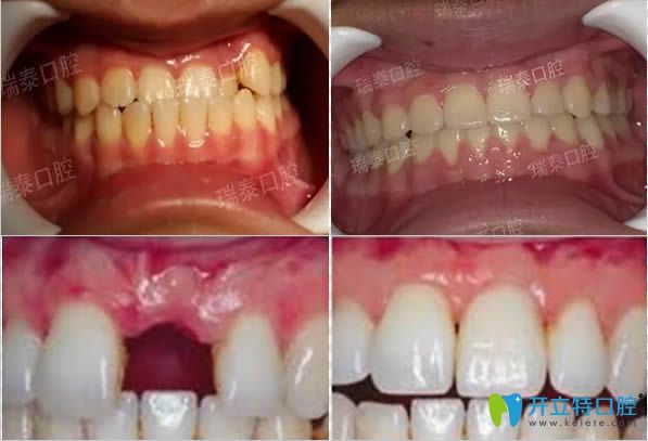青島瑞泰地包天矯正及門牙缺失種植前后對(duì)比效果 青島瑞泰地包天矯正及門牙缺失種植前后對(duì)比效果