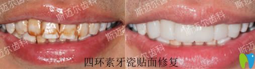 北京斯邁爾齒科楊雷牙齒美學(xué)修復(fù)效果圖