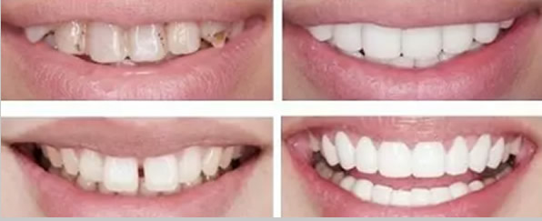 黃牙/黑牙/牙縫大怎么治 佛山壹加壹口腔全瓷貼面幫您修復(fù)