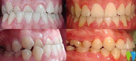 北京斯邁爾齒科骨性錯(cuò)合牙齒正畸效果圖 北京斯邁爾齒科骨性錯(cuò)合牙齒正畸效果圖