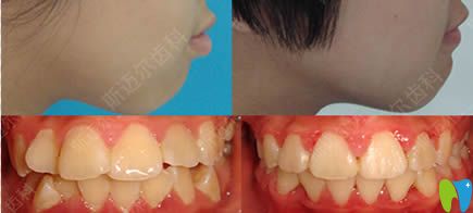 北京斯邁爾口腔牙齒不齊/噘嘴矯正效果圖 北京斯邁爾口腔牙齒不齊/噘嘴矯正效果圖
