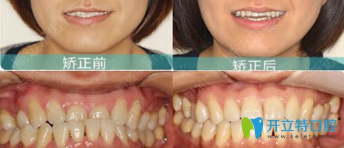 北京斯邁爾齒科張棟梁舌側(cè)正畸效果圖 北京斯邁爾齒科張棟梁舌側(cè)正畸效果圖