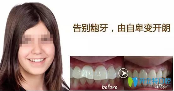 佛山壹加壹齙牙矯正前后對(duì)比照片