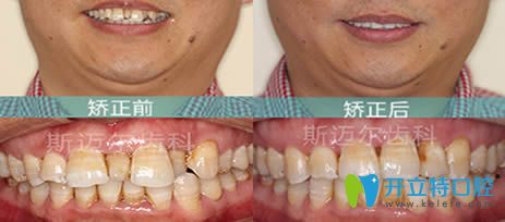 北京斯邁爾齒科張棟梁牙齒正畸效果對比圖 北京斯邁爾齒科張棟梁牙齒正畸效果對比圖