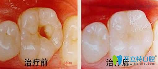 泉州維樂(lè)口腔謝碧享根管治療效果圖