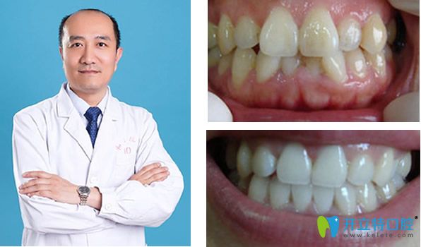 李向飛醫(yī)生和他矯正牙齒前后效果對(duì)比照 李向飛醫(yī)生和他矯正牙齒前后效果對(duì)比照