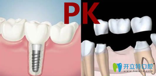 關(guān)于種牙好還是鑲牙好？請看價(jià)格/壽命/優(yōu)勢三方面大比拼