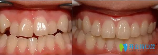天津美萊口腔正畸前后對比照片